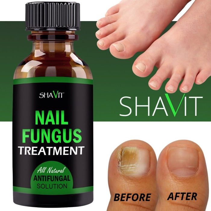 ANTI FUNGAL TREATMENT EXTRA STRENGTH TOENAIL FUNGUS ATHLETES FOOT FUNGI NAIL - Kannabliss Exotics